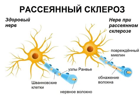 рассеянный склероз передается по наследству|Рассеянный склероз — Википедия